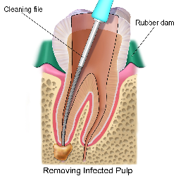 Root Canal Treatment - Dr. Dental