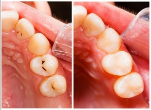 Teeth Fillings in Chelsea, CT