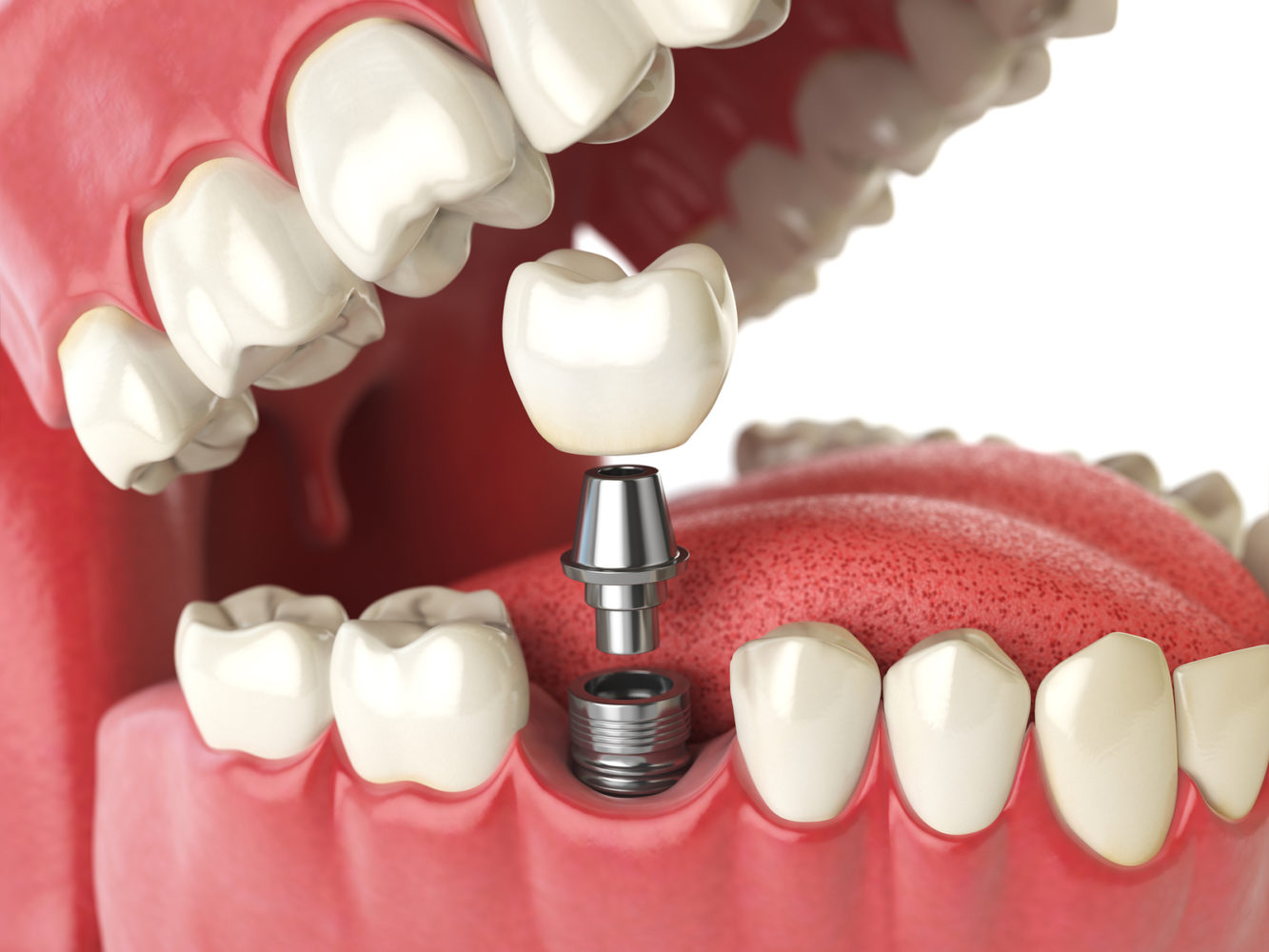 Dental Implants & Dentures: What’s the Difference?