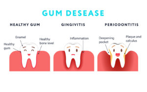 Eliminate Plaque & Stop Gum Disease – Advice Straight From the Dental Office