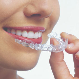 Invisalign-2