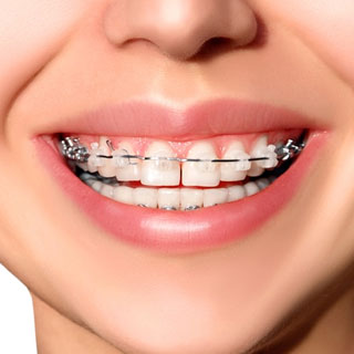 Breakthrough Orthodontic Expenses: How Much Do Invisalign Retainers Cost? -  Smile Studio Boston