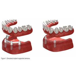 Dentures-2