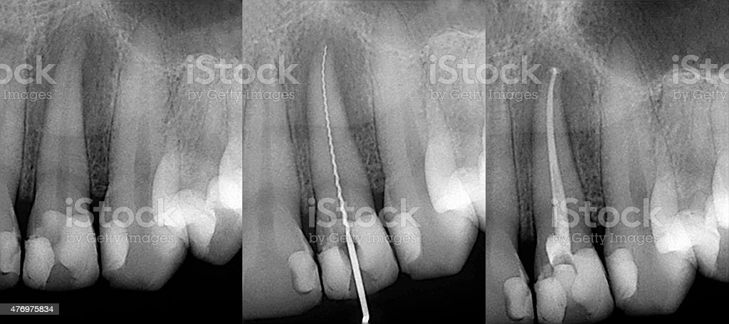 Dentures-2